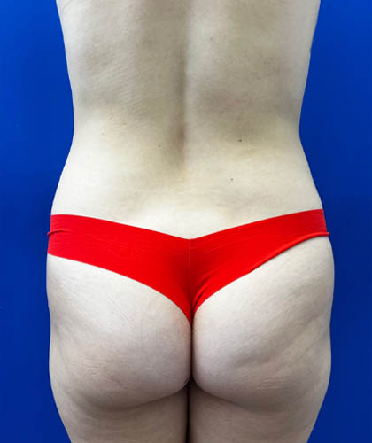 Liposuction case #9666