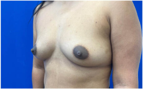 Breast Augmentation case #9540