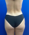 Liposuction case #9666