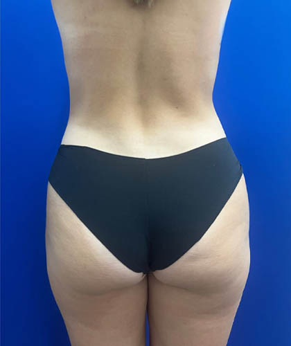 Liposuction case #9666