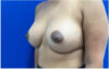 Breast Augmentation case #9540