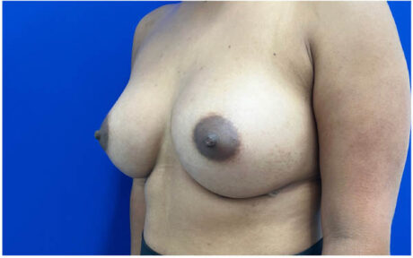 Breast Augmentation case #9540