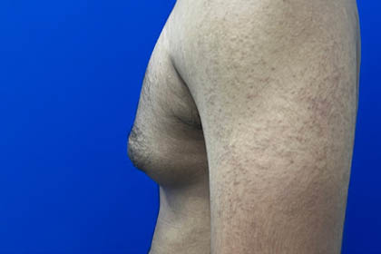 Gynecomastia case #9675