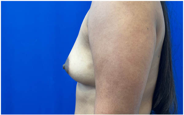 Breast Augmentation case #9540