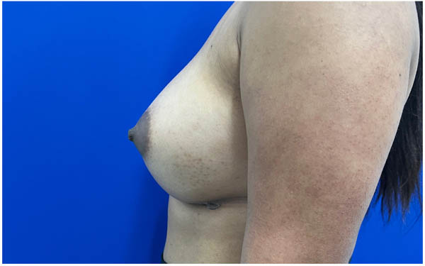 Breast Augmentation case #9540