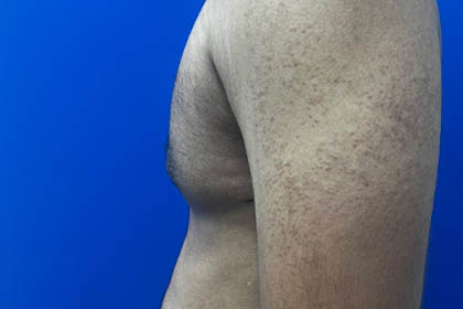 Gynecomastia case #9675