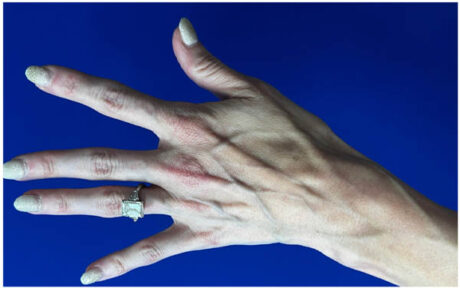 Hand Rejuvenation case #9551