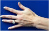 Hand Rejuvenation case #9551
