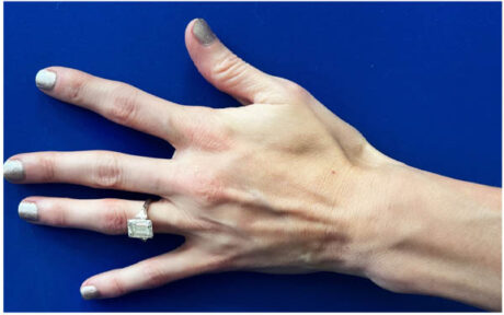 Hand Rejuvenation case #9551