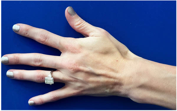 Hand Rejuvenation case #9551