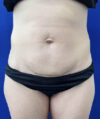 Tummy Tuck case #11321