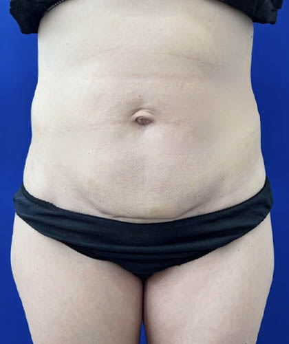 Tummy Tuck case #11321