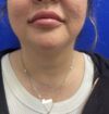 Neck Liposuction case #11245