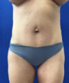 Tummy Tuck case #11321