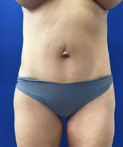Tummy Tuck case #11321
