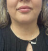 Neck Liposuction case #11245