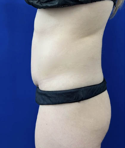Tummy Tuck case #11321