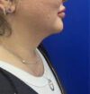 Neck Liposuction case #11245