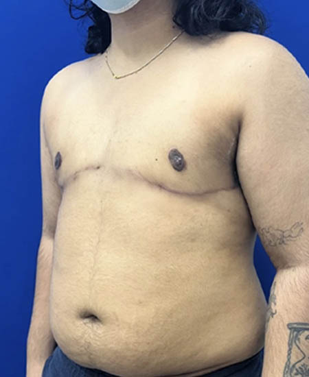 FTM with Nipple Grafts case #11254