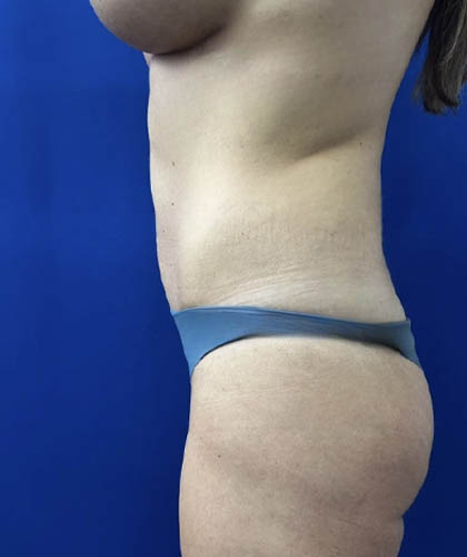 Tummy Tuck case #11321