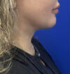 Neck Liposuction case #11245
