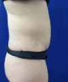 Tummy Tuck case #11321