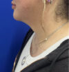 Neck Liposuction case #11245