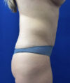 Tummy Tuck case #11321
