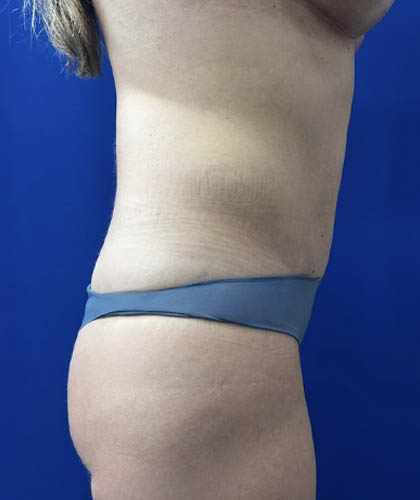 Tummy Tuck case #11321