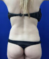 Tummy Tuck case #11321