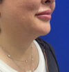 Neck Liposuction case #11245