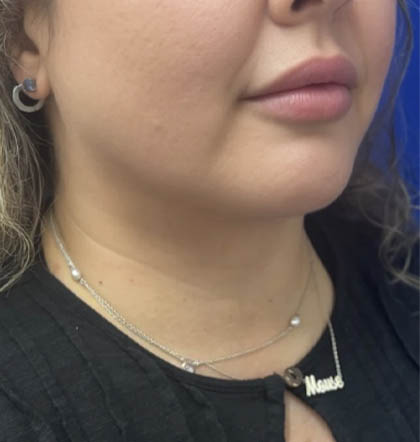 Neck Liposuction case #11245