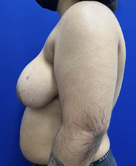 FTM with Nipple Grafts case #11254