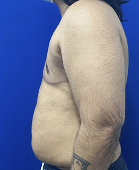 FTM with Nipple Grafts case #11254