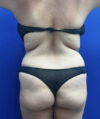Tummy Tuck case #11330