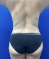 Tummy Tuck case #11330