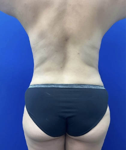 Tummy Tuck case #11330