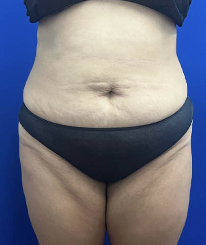 Tummy Tuck case #11330