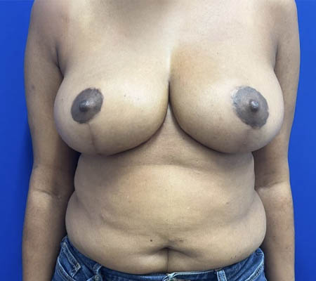 Breast Lift case #11266