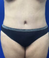 Tummy Tuck case #11330