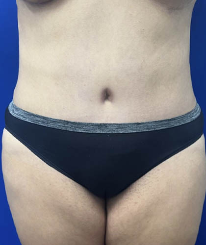 Tummy Tuck case #11330