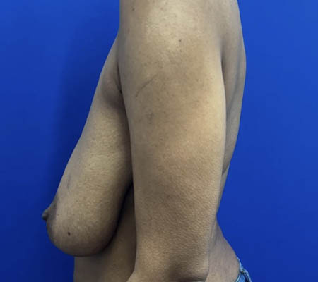 Breast Lift case #11266