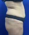 Tummy Tuck case #11330