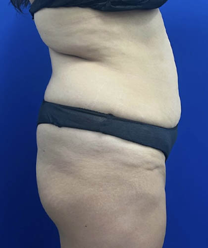 Tummy Tuck case #11330