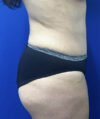 Tummy Tuck case #11330