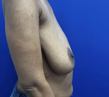 Breast Lift case #11266