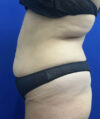 Tummy Tuck case #11330