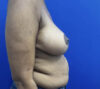 Breast Lift case #11266