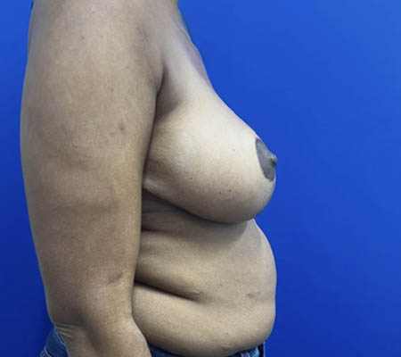 Breast Lift case #11266