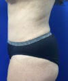 Tummy Tuck case #11330